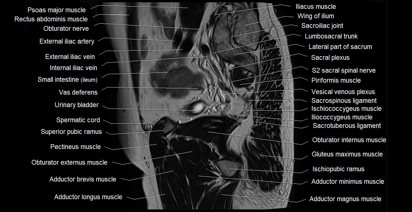 male pelvis sagittal cross sectional anatomy 3T mri image 35.webp